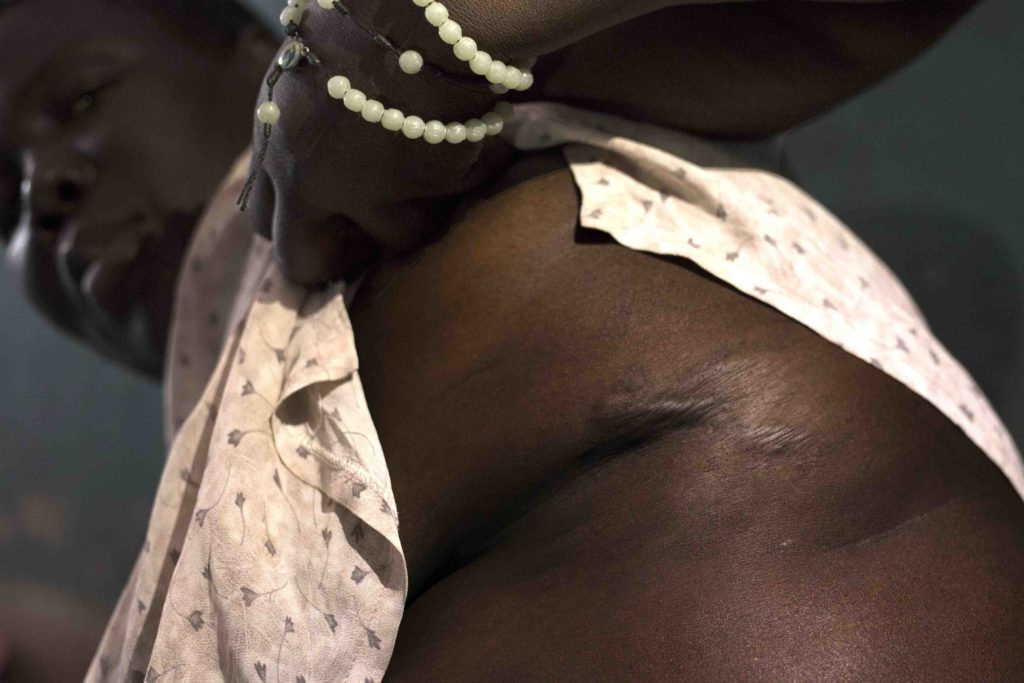 his is the part of Keji's body that was affected by gun powder during the bullet fire cross in her to Pageri, South Sudan in 2005.